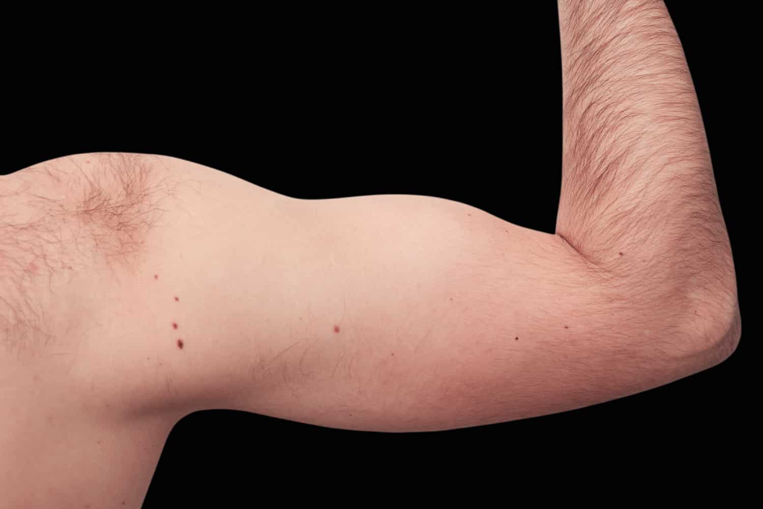 Back view of a man's right arm after to Emsculpt procedure at Regeneris Medspa