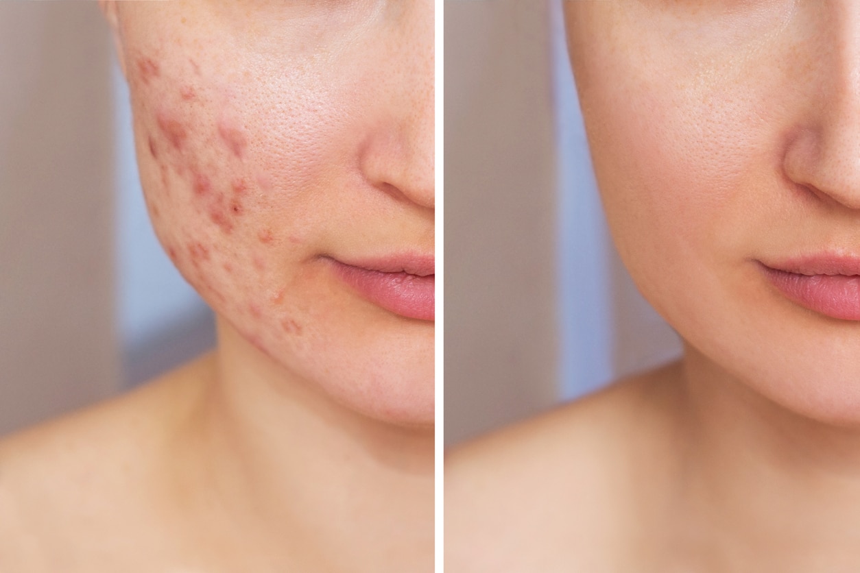 A side-by-side, before & after closeup of a young woman’s right cheek with & without red, raised acne bumps.