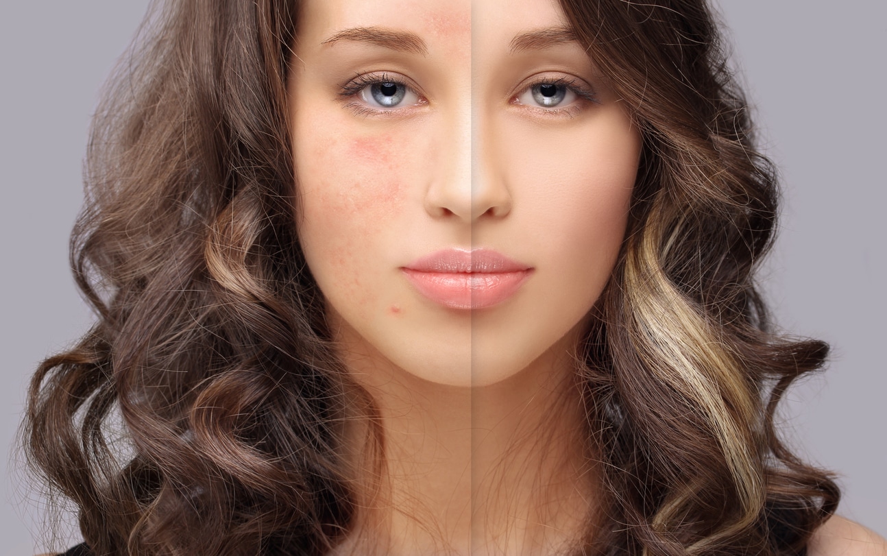 A before-and-after image of a beautiful woman with curly hair who has had her blemishes treated for smooth skin