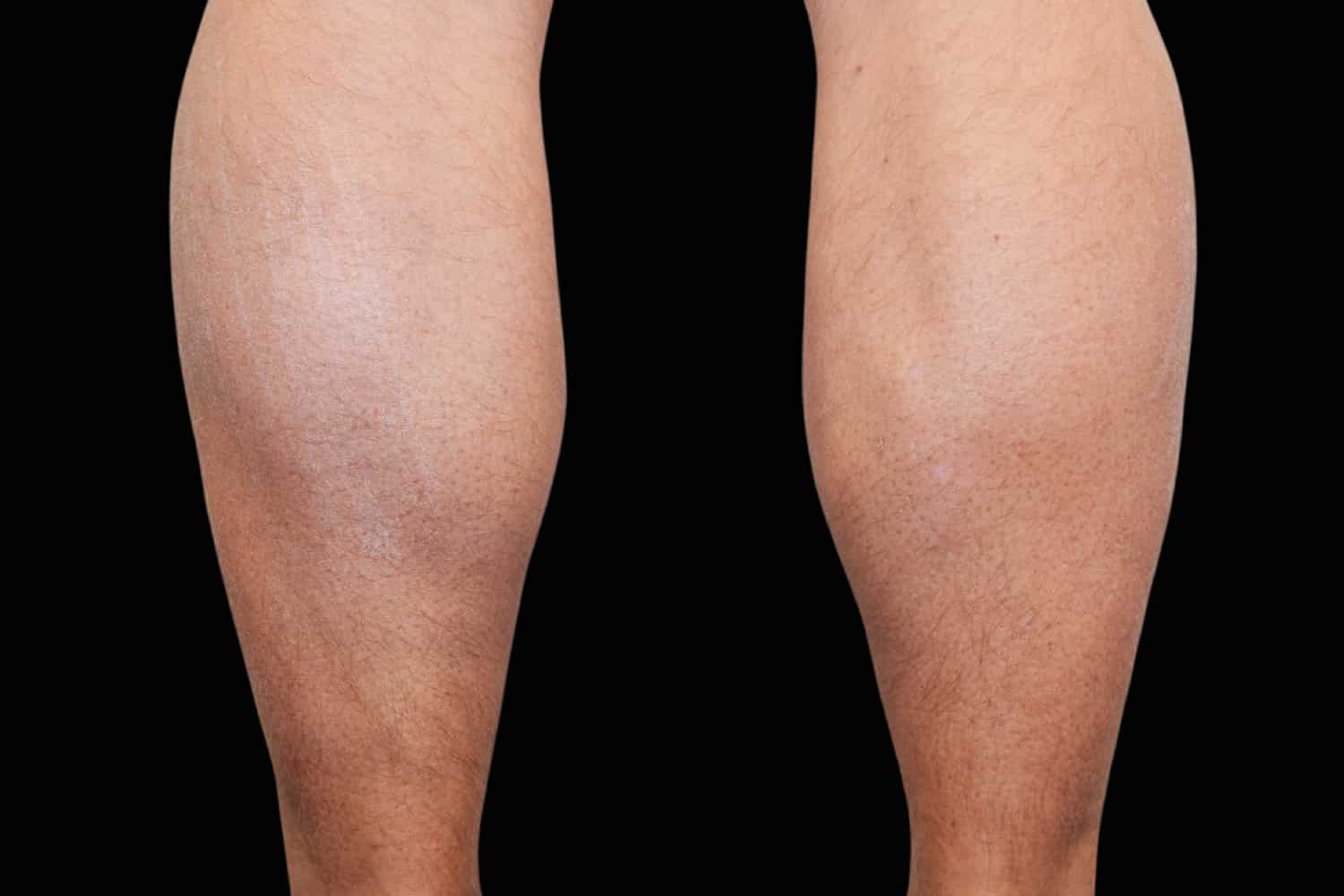 Back of a person's calves after to Emsculpt at Regeneris Medspa looking more defined
