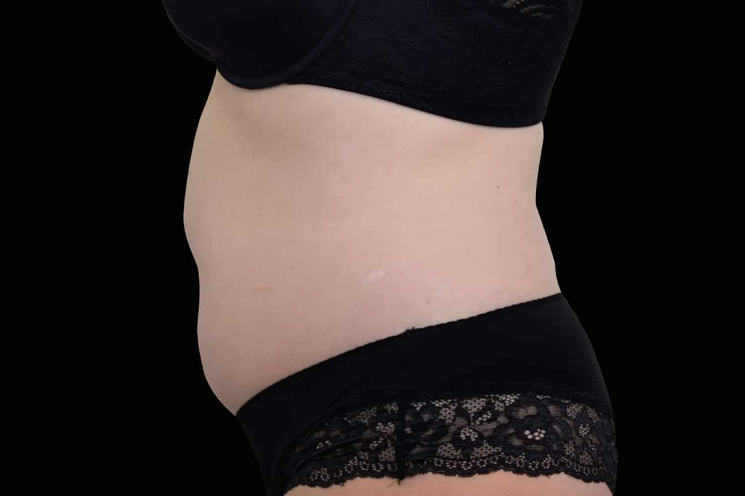 Close up side view of a woman's belly after EMSCULPT NEO procedure at Regeneris Medspa, Boston