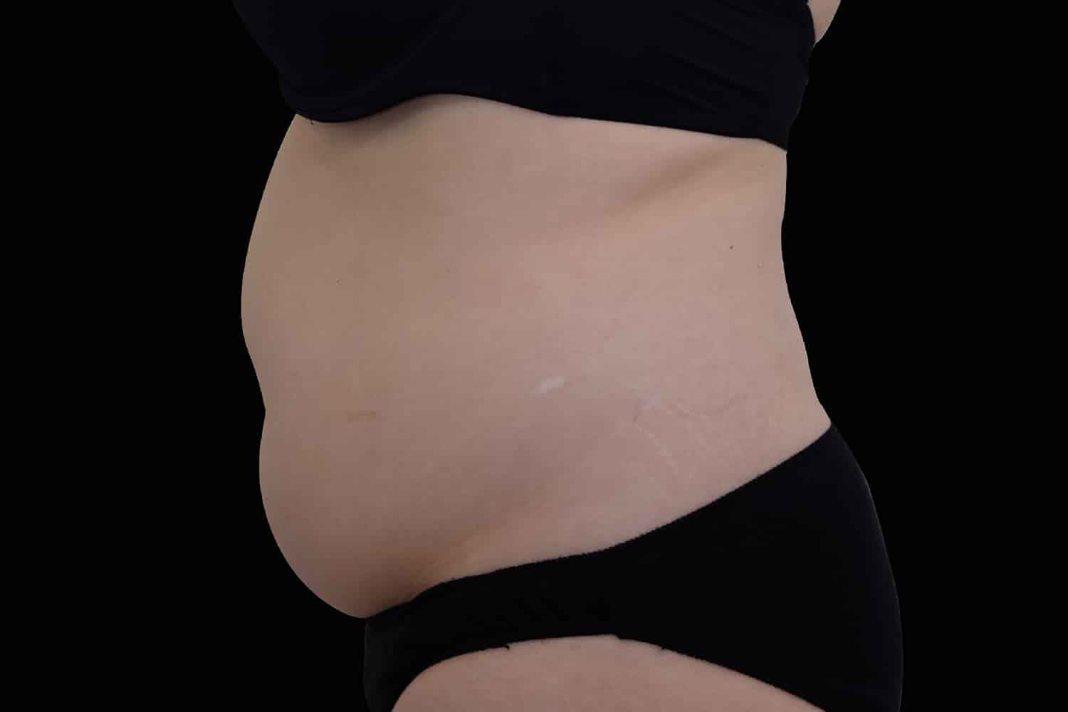 Close up side view of a woman's belly before EMSCULPT NEO procedure at Regeneris Medspa, Boston