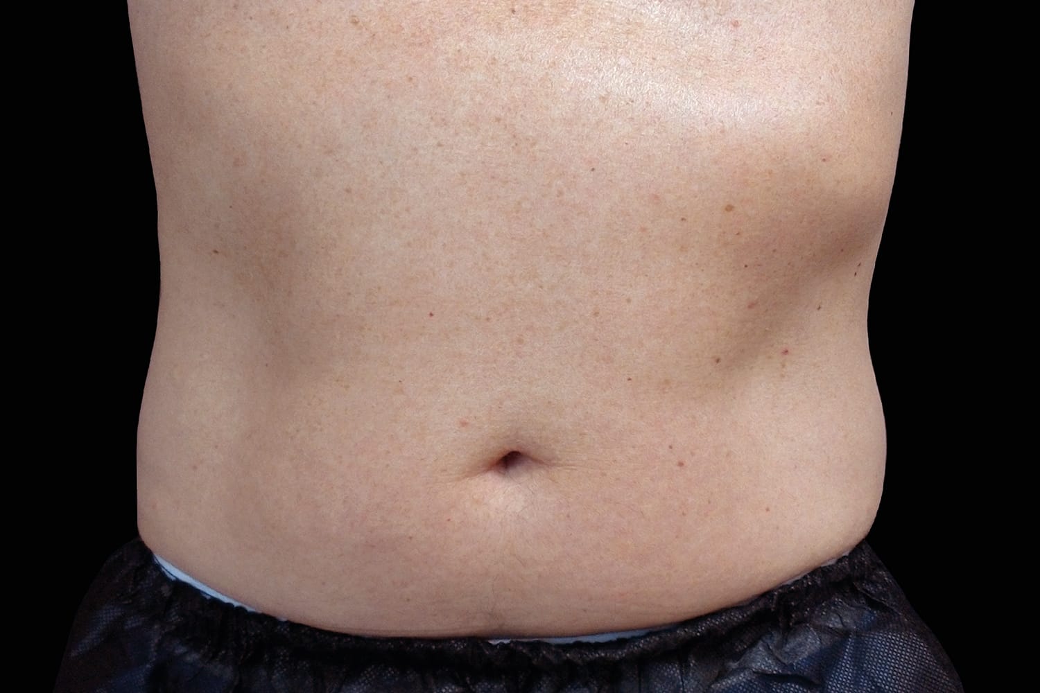 Close up of a man's belly before Emsculpt NEO