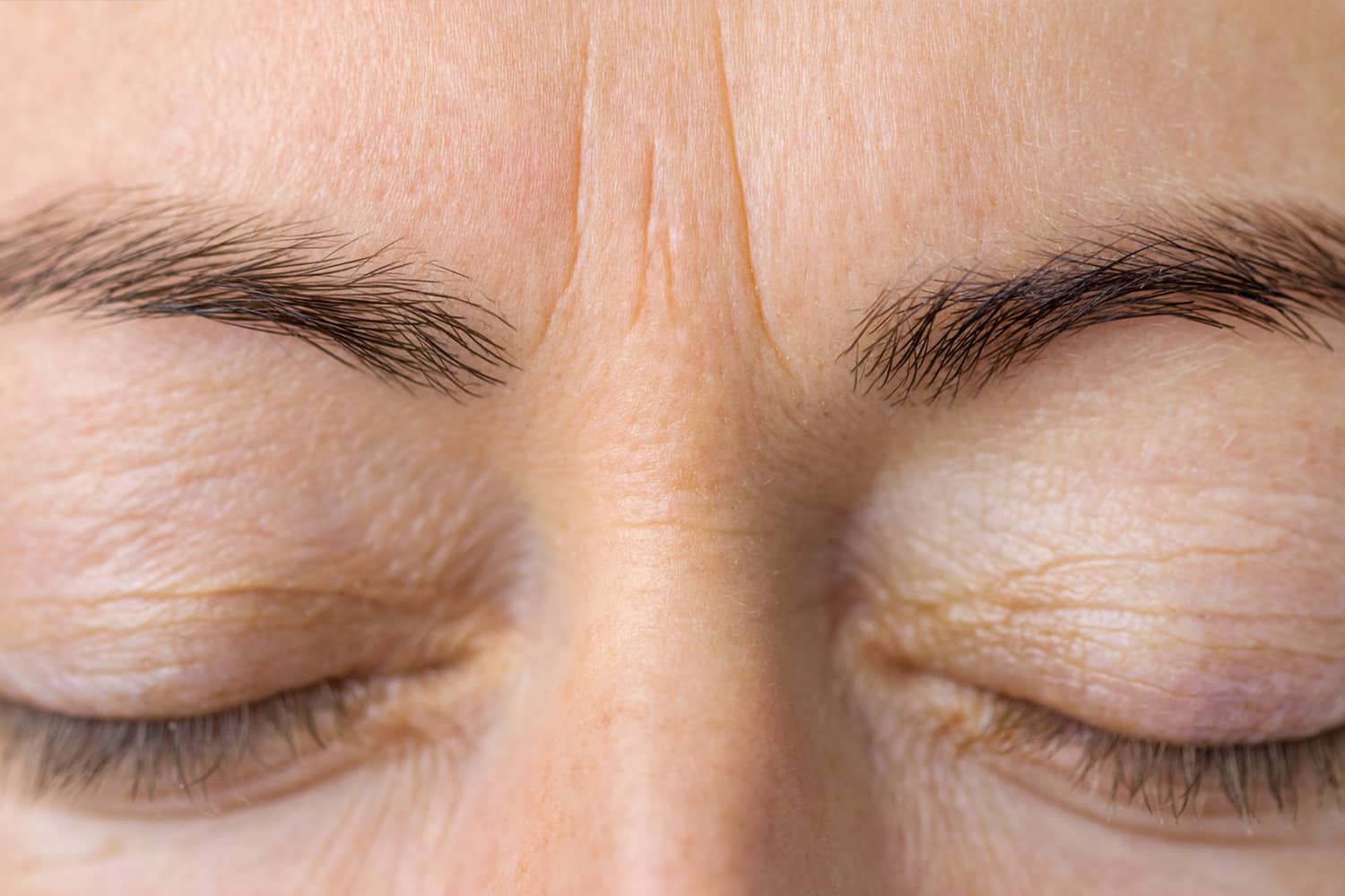 Close up of a woman's forehead and eyes area with wrinkles before Juvederm at Regeneris Medspa