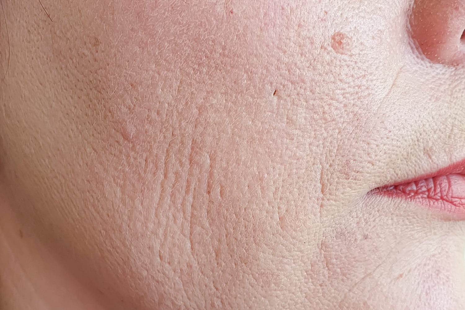 Close up of a woman's cheek with open pores prior to Juvederm treatment at Regeneris Medspa