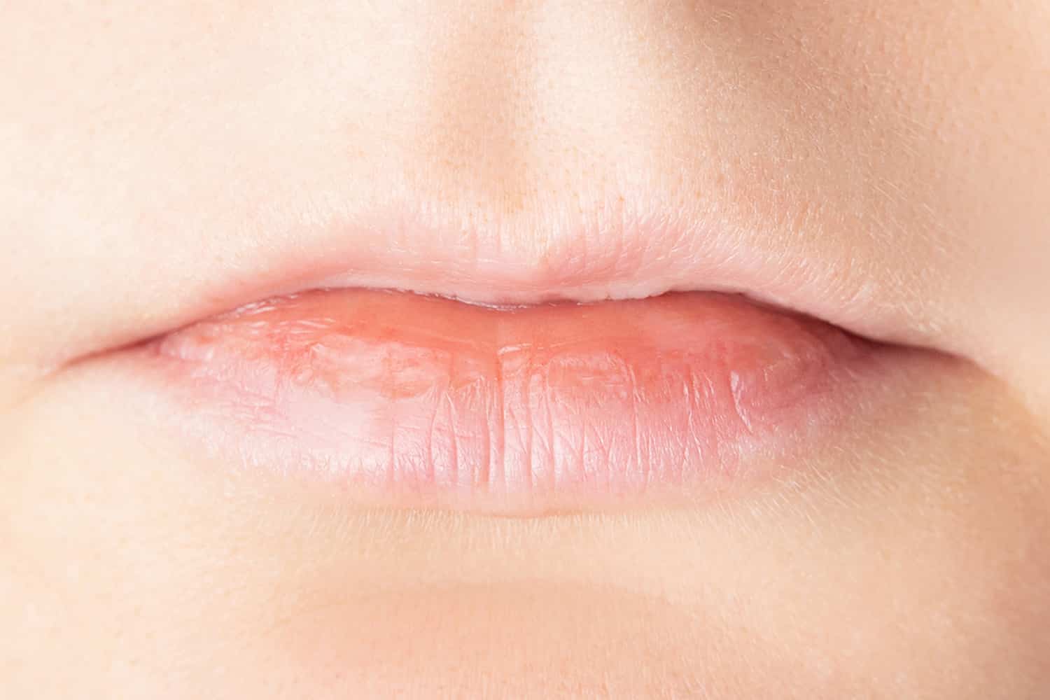 A close up of a lip prior to Juvederm procedure