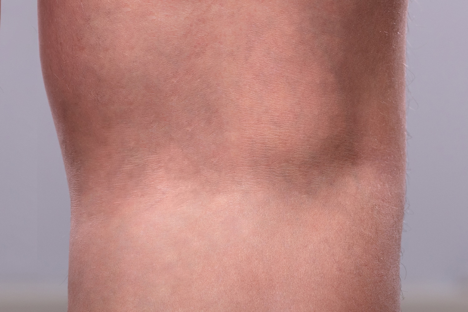 Man's back calf showing varicose veins after laser vein treatment
