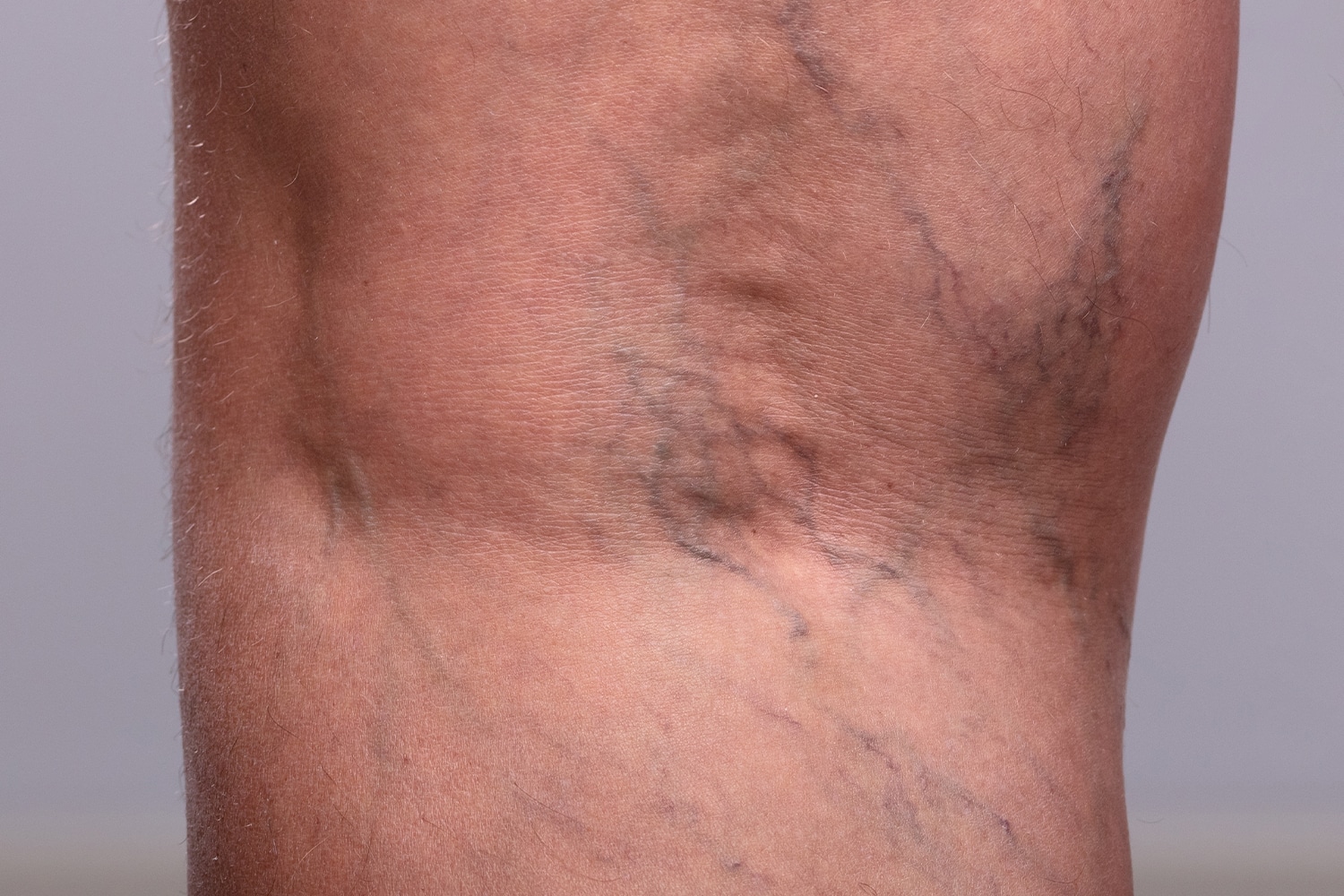 Man's back calf showing varicose veins before laser vein treatment