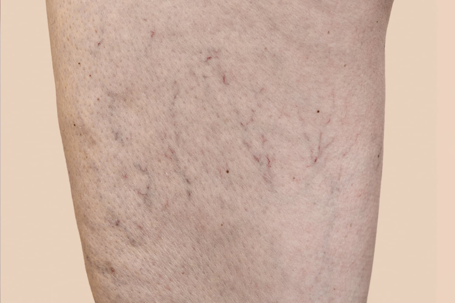 A client's leg with varicose veins prior to laser vein treatment at Regeneris Medspa