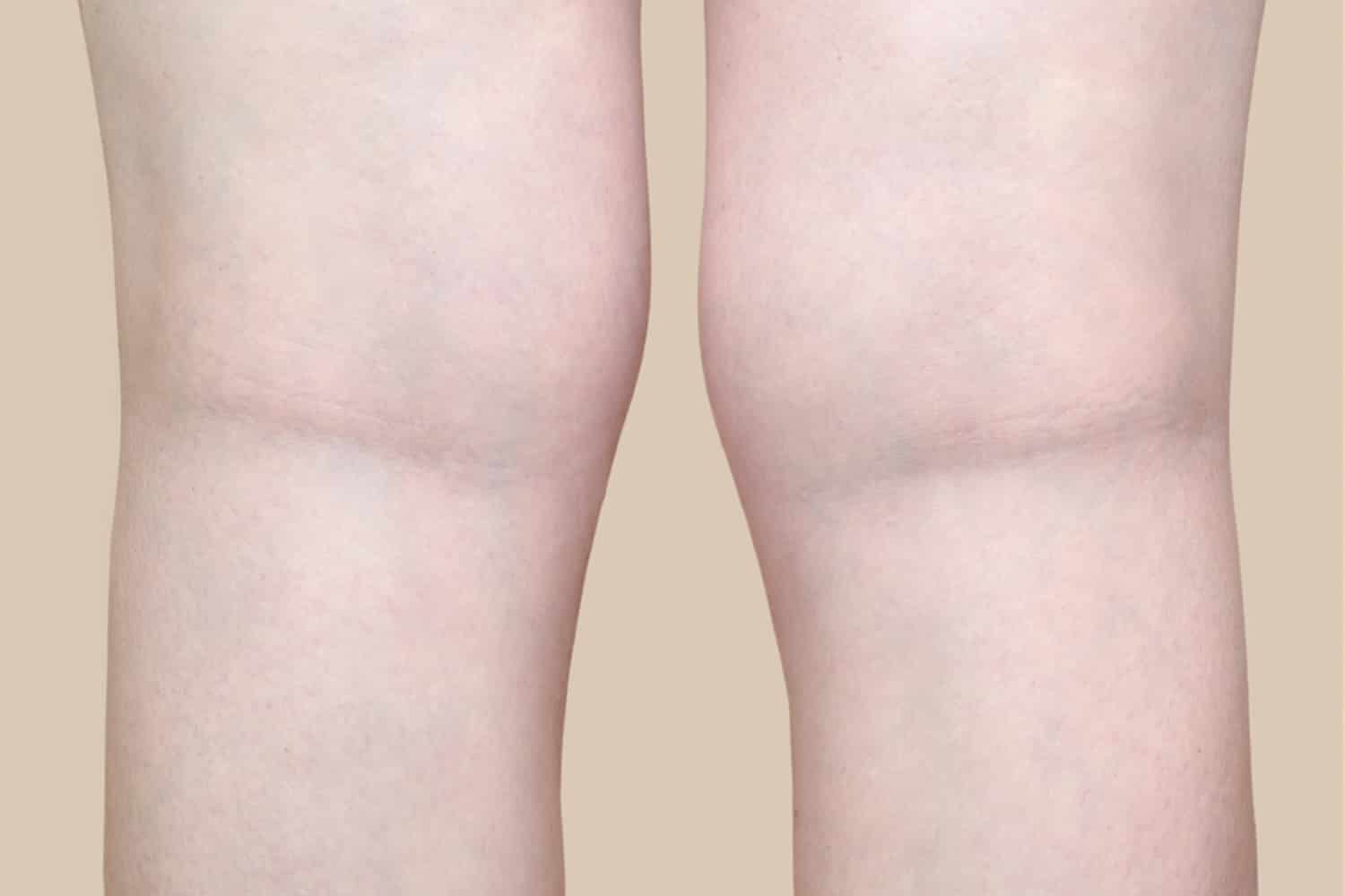 back view of a woman's calves after to laser vein treatment at Regenris Medspa without varicose veins