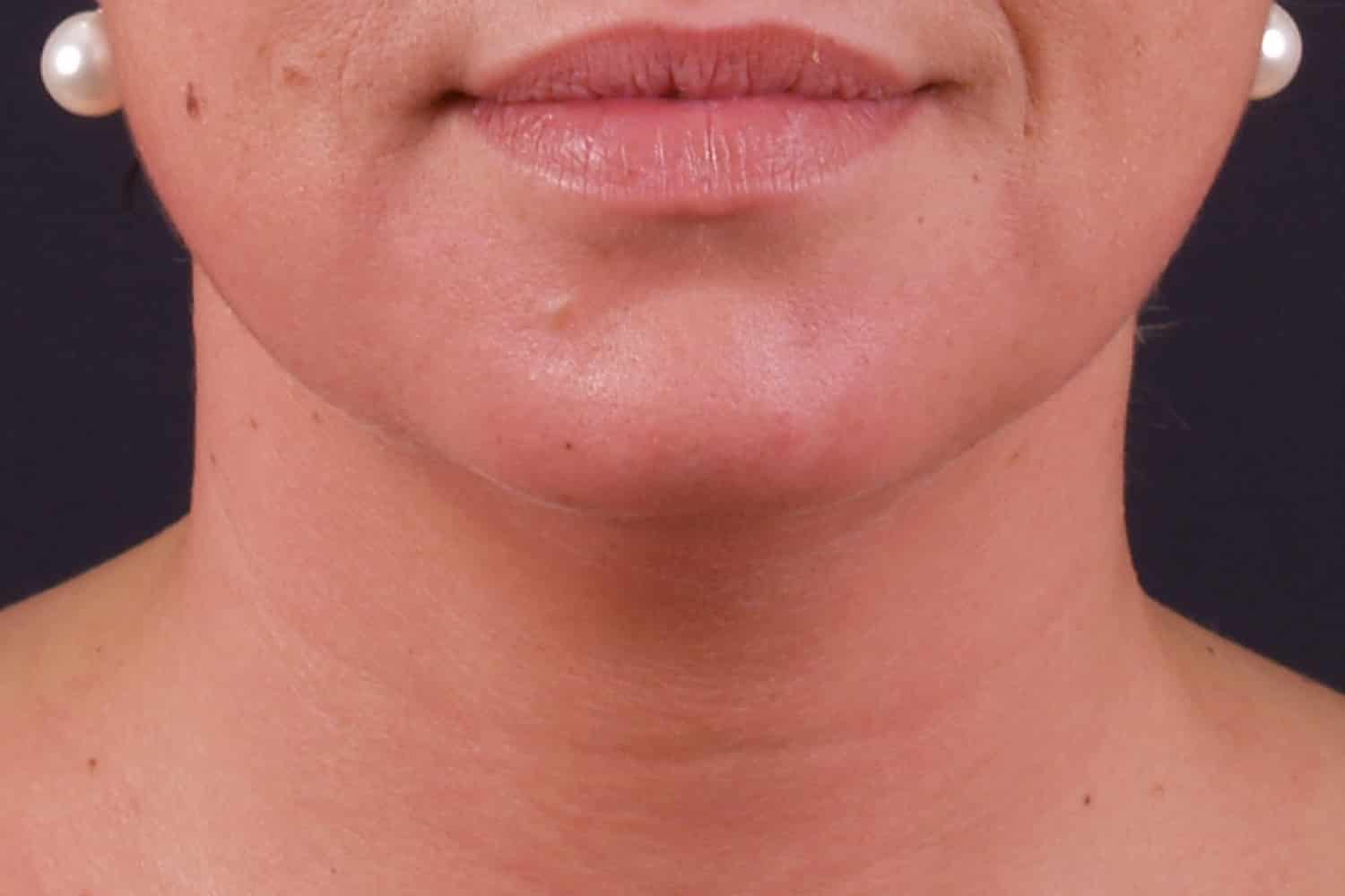 Close up of a woman's chin after Exilis Ultra treatment