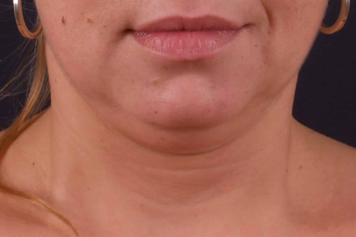 Close up of a woman's double chin before Exilis Ultra treatment