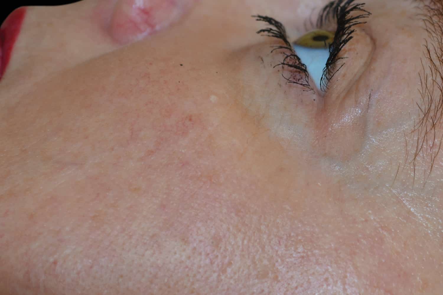 Close up eye after Exilis Ultra treatment without the wrinkles