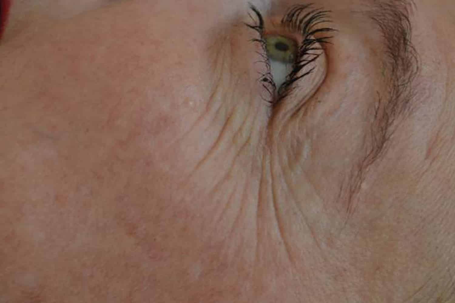 Close up eye wrinkles before Exilis Ultra treatment