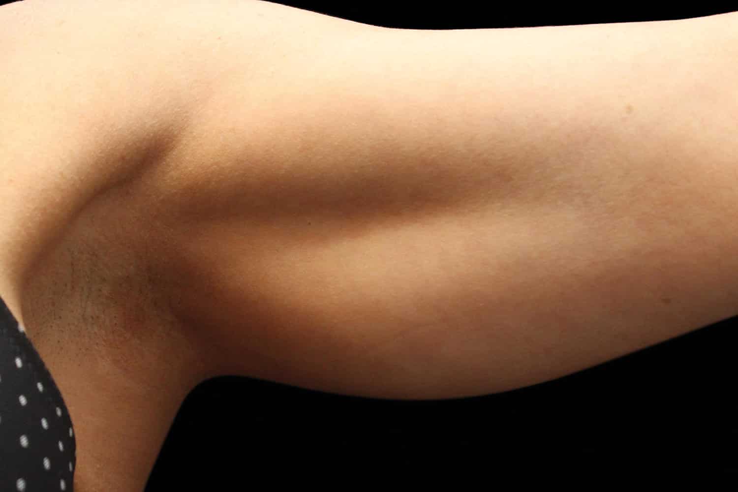 A person's arm after Exilis Ultra Treatment of Regeneris
