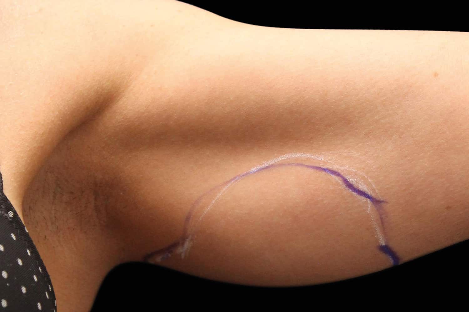 A person's arm with their excess skin marked for Exilis Ultra Treatment of Regeneris