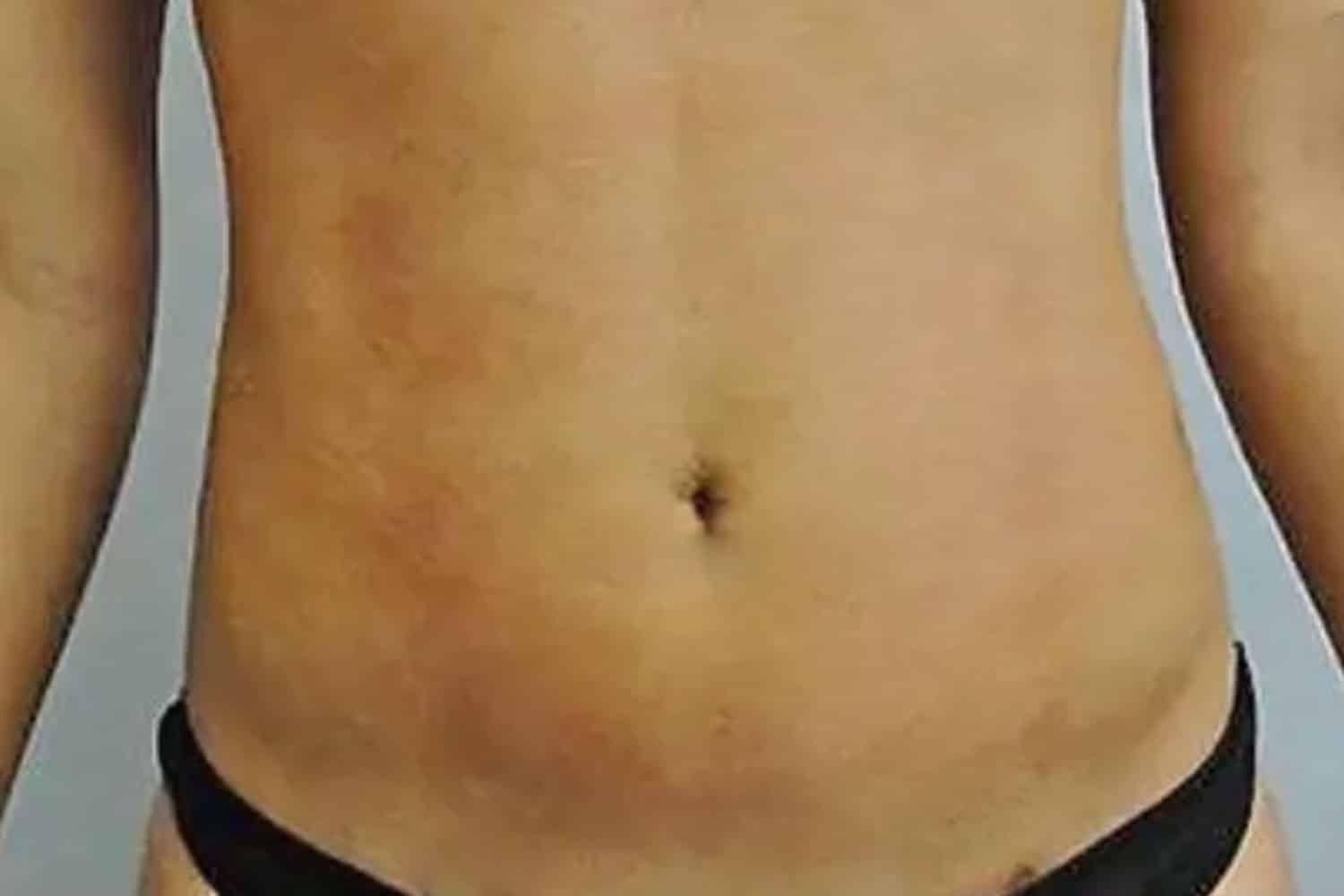 A woman's mid torso after fat transfer at Regeneris