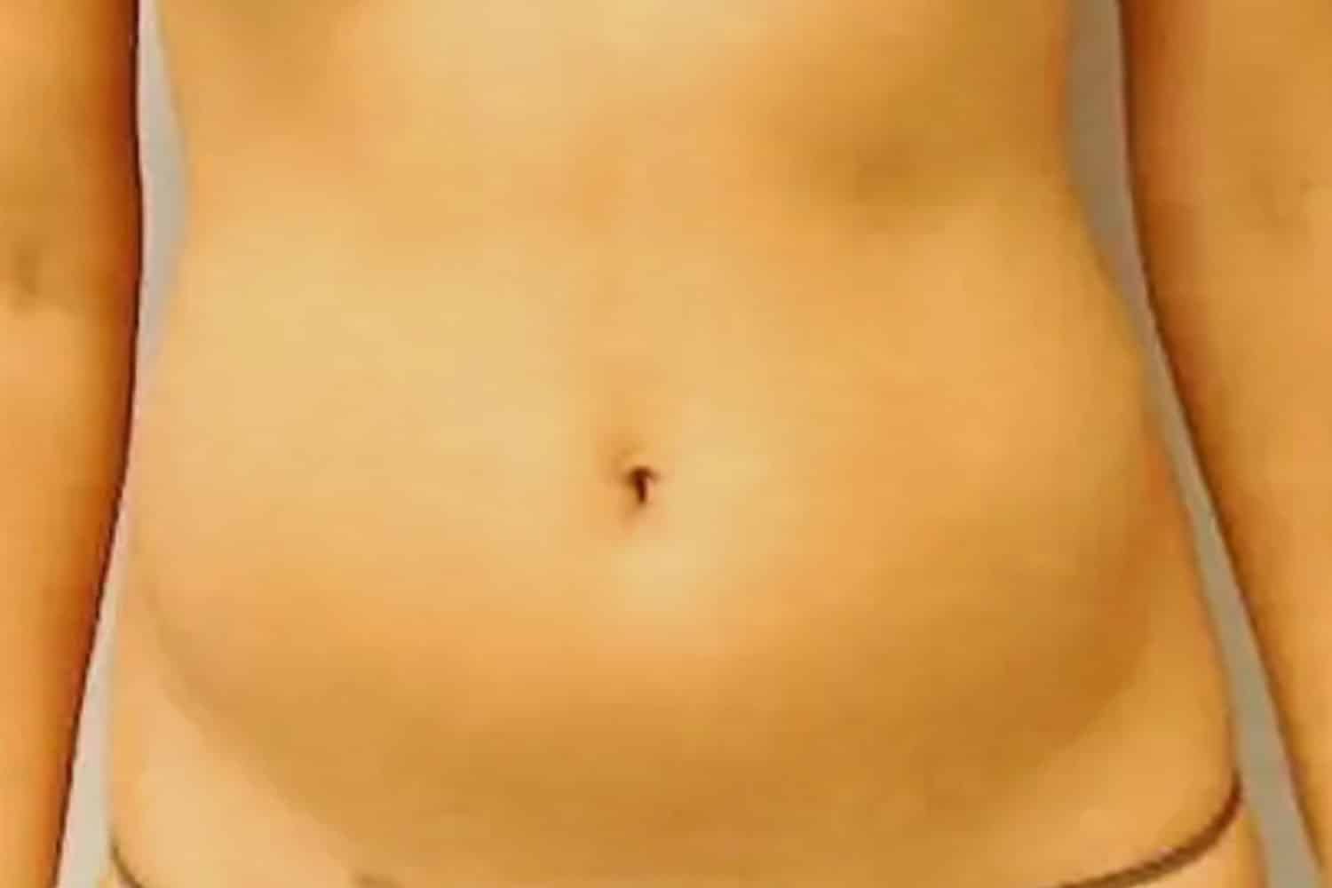 A woman's mid torso after fat transfer at Regeneris Medspa