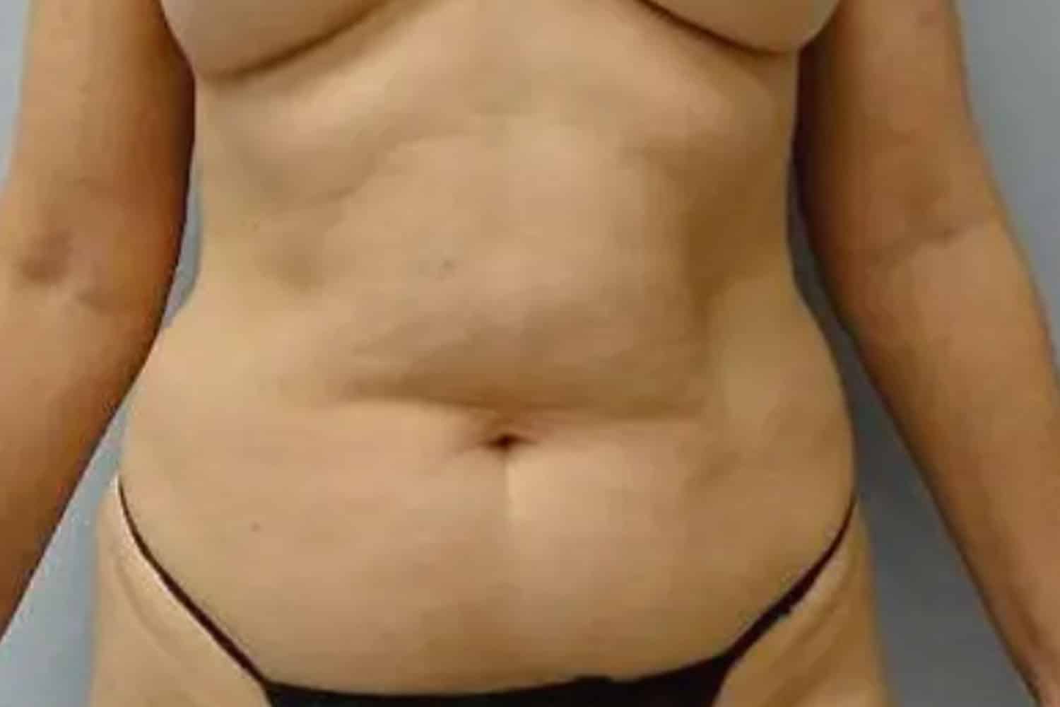 A woman's mid torso for fat transfer at Regeneris