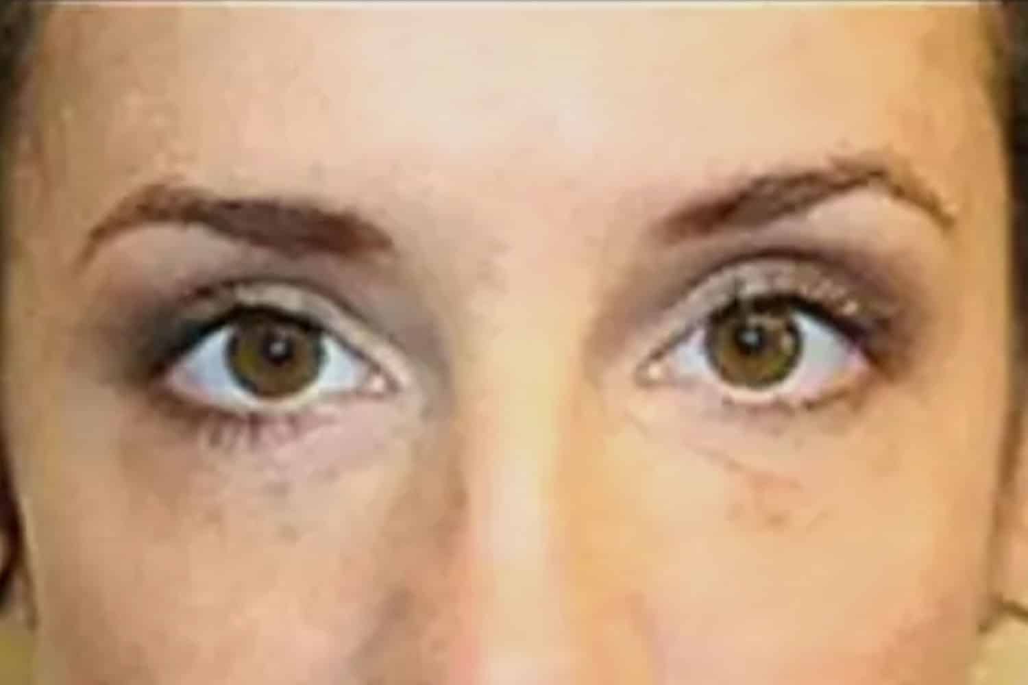 close up of a person's eyes for fat transfer and injections at Regeneris
