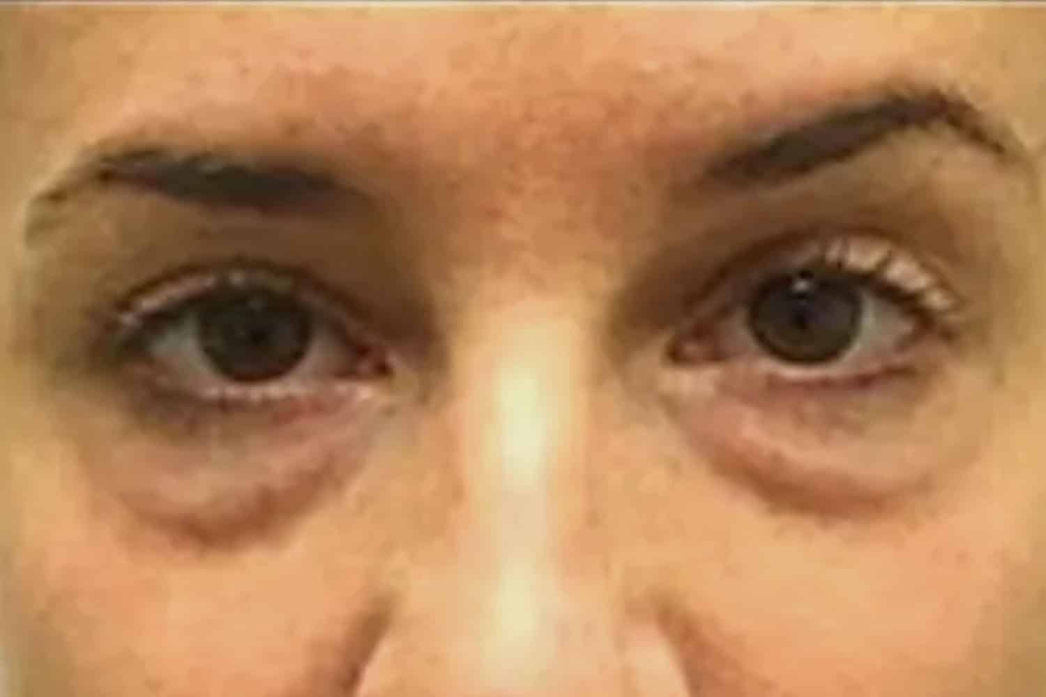 close up of a person's eyes after fat transfer and injections at Regeneris