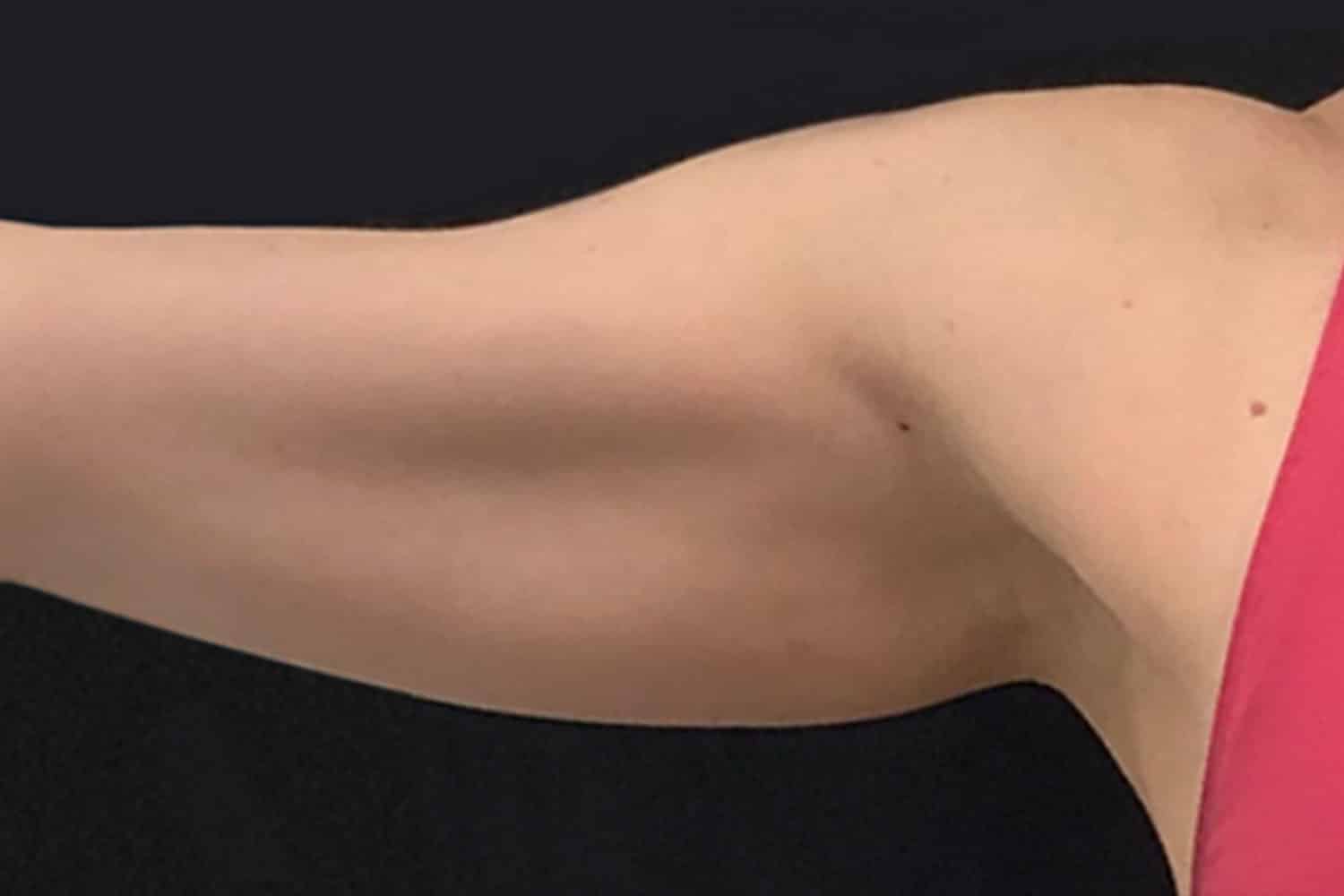 right arm with excess skin after Trusculpt procedure at Regeneris
