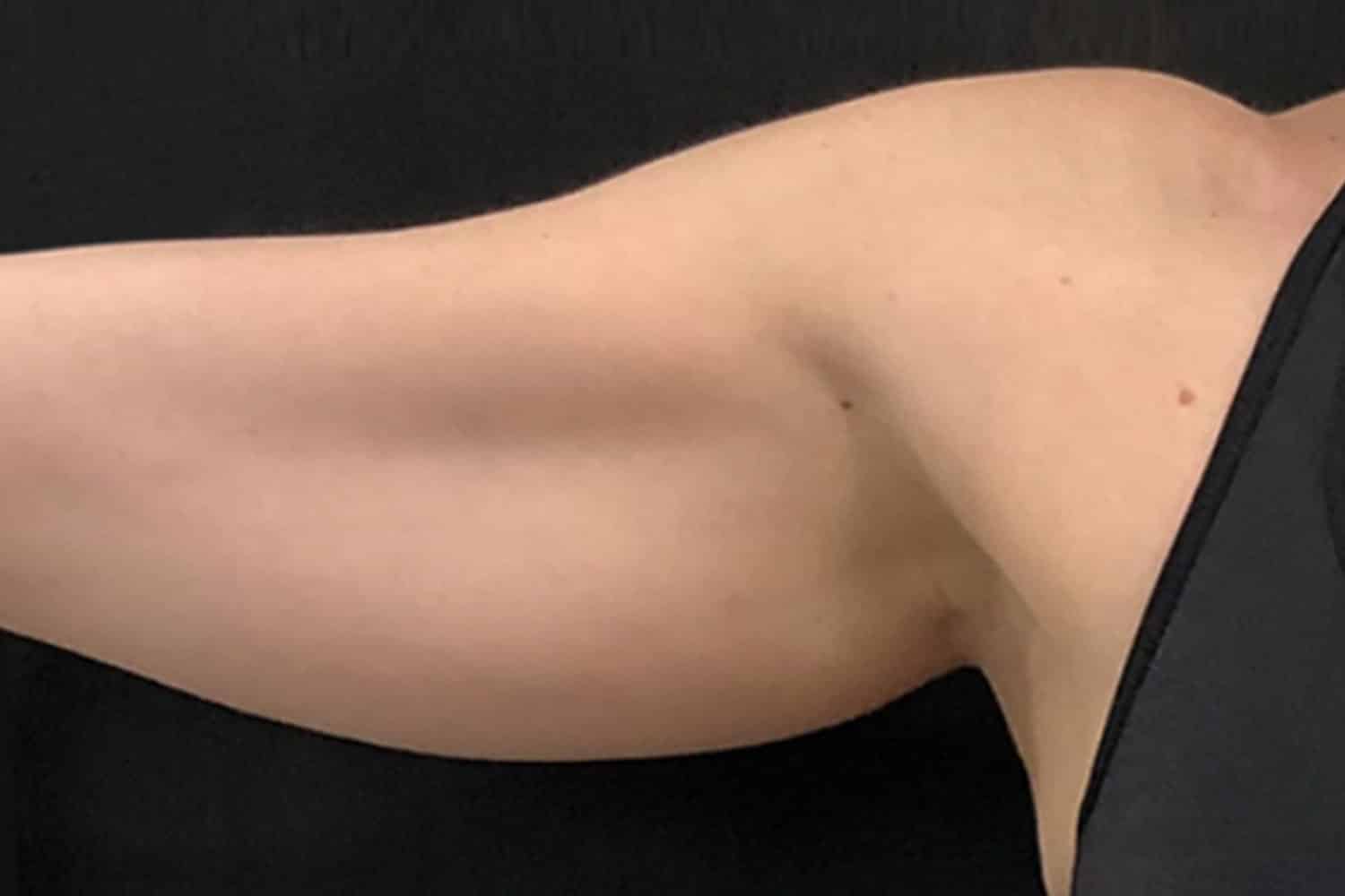 right arm with excess skin for Trusculpt procedure at Regeneris