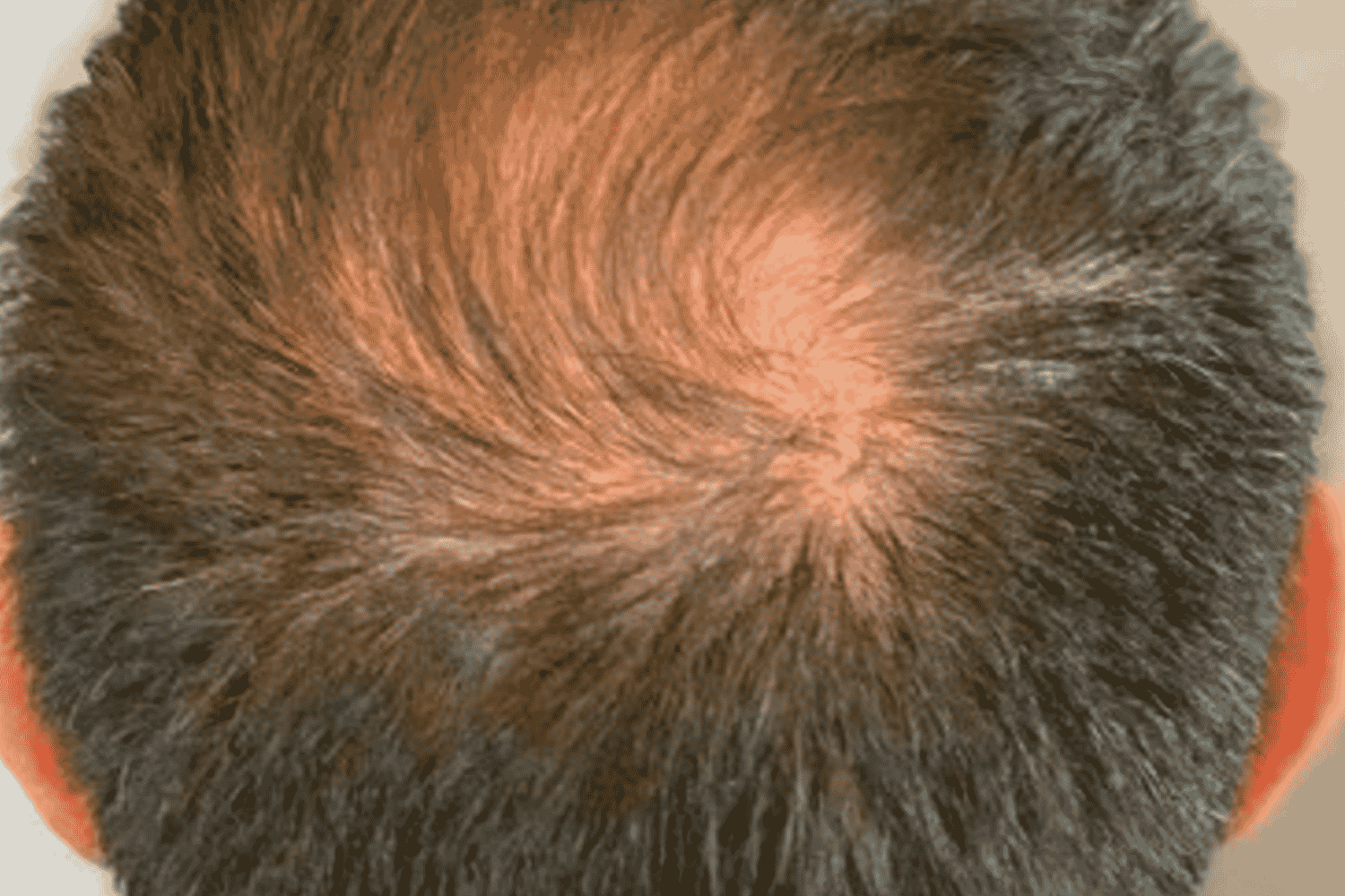 Close up shot of a man's scalp after Keralase treatment at Regeneris