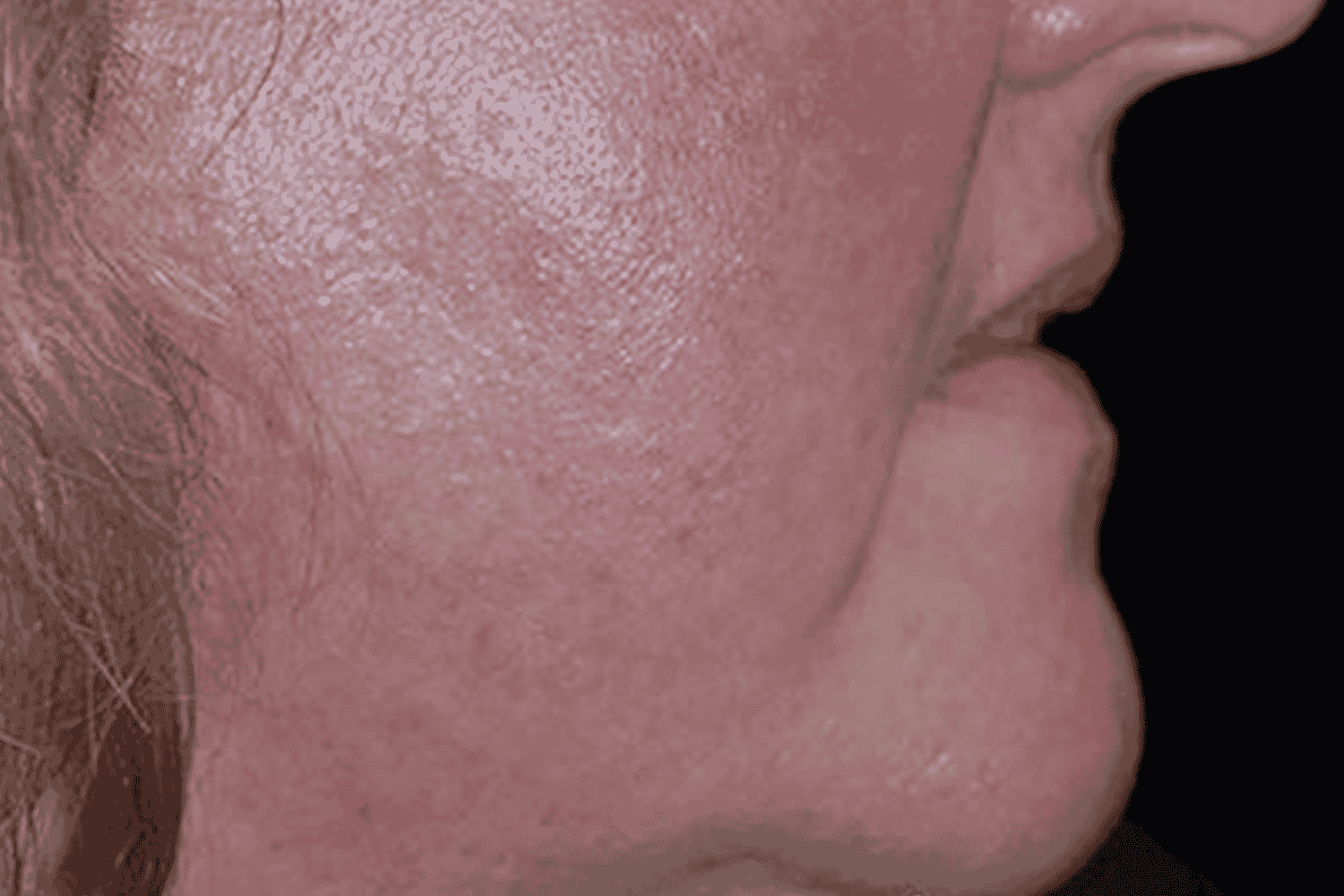 A close up of an aged woman's cheek before Laser Genesis for Skin Tightening treatment at Regeneris