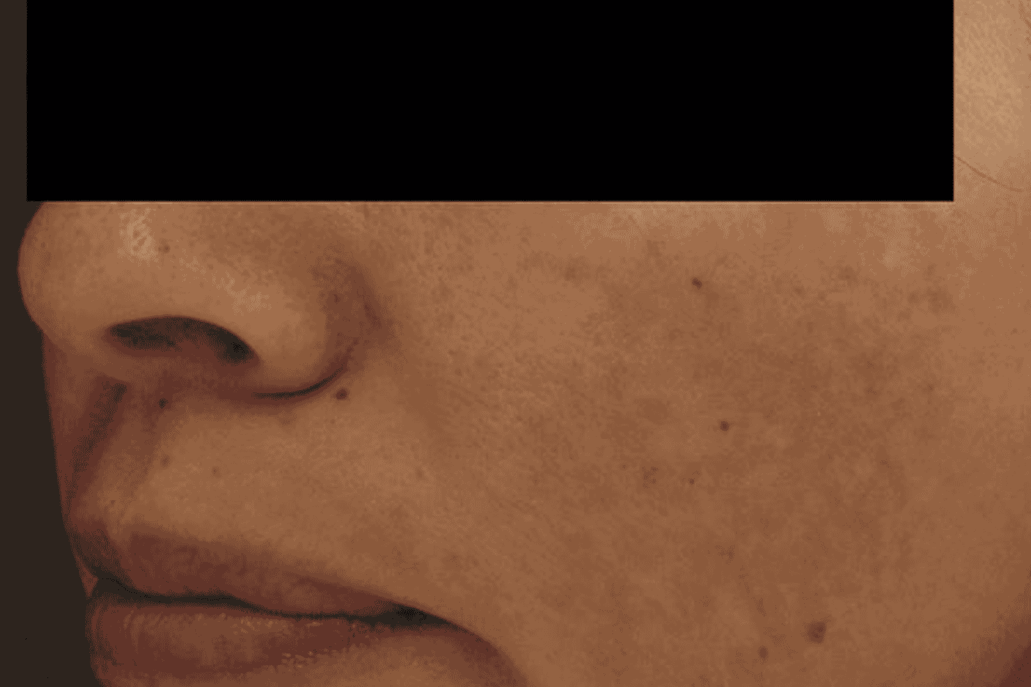 A close up of cheek after Laser Genesis for Skin Tightening treatment at Regeneris