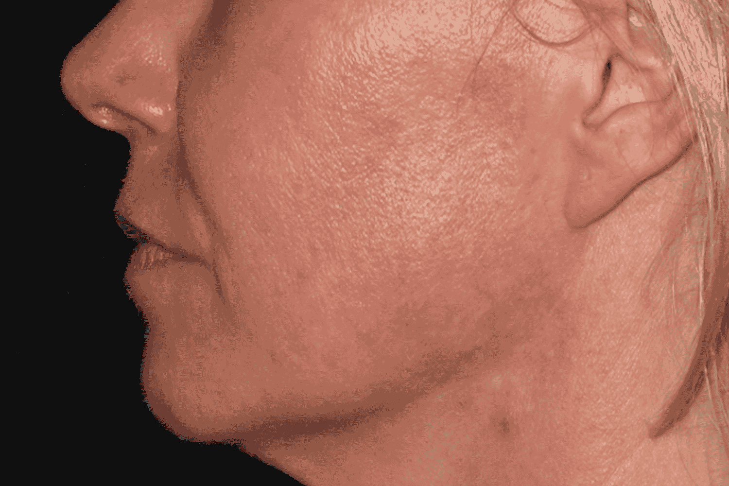 a close up of a person's side cheek after LaserMD treatment at Regeneris