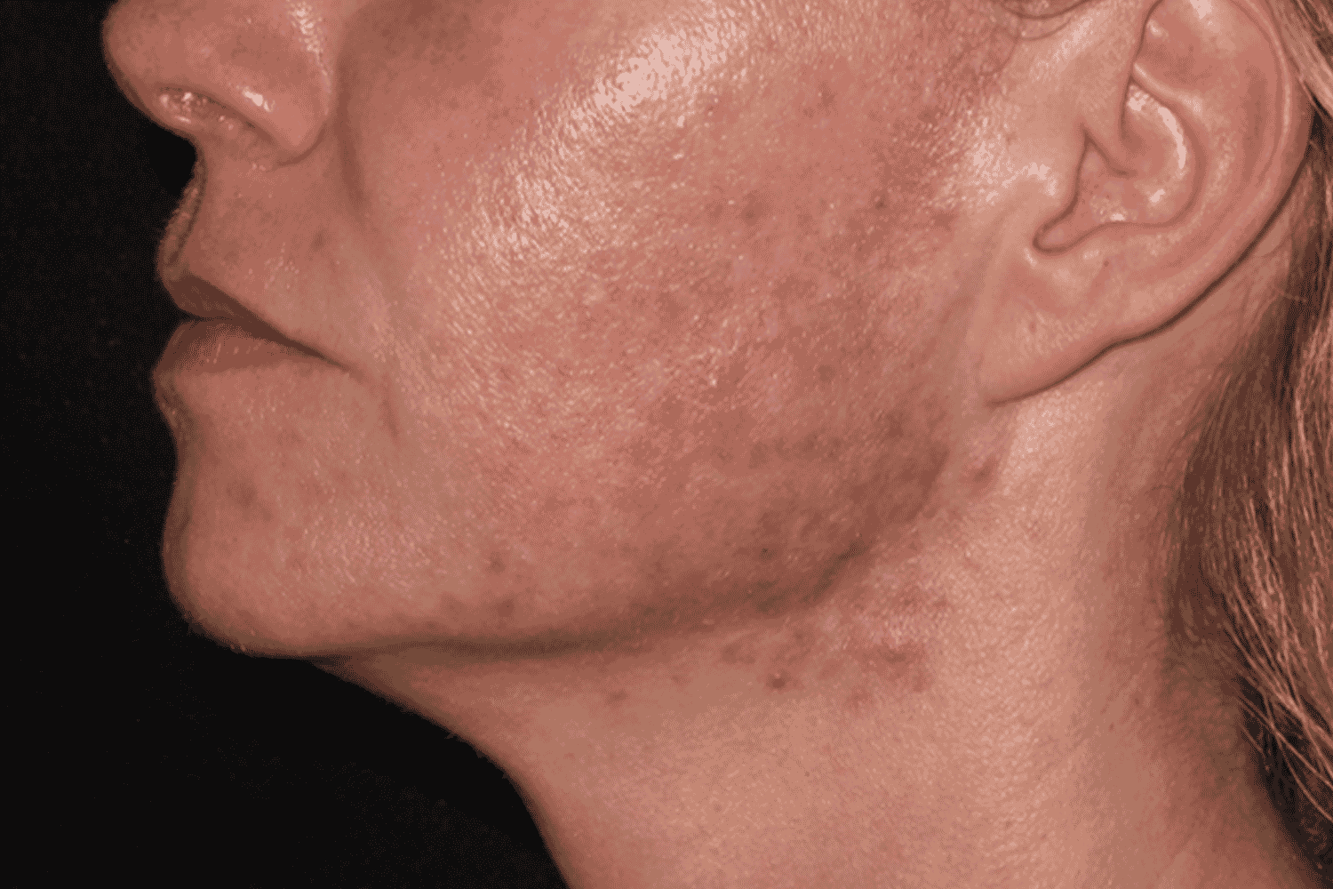 a close up of a person's side cheek before LaserMD treatment at Regeneris