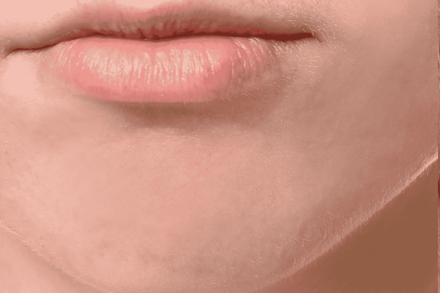 a close up of a person's chin after LaserMD treatment at Regeneris