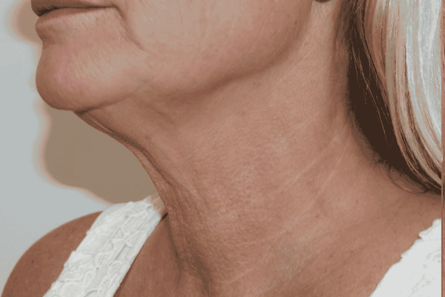 Close neck shot after LaseMD & Genius RF procedure at Regeneris