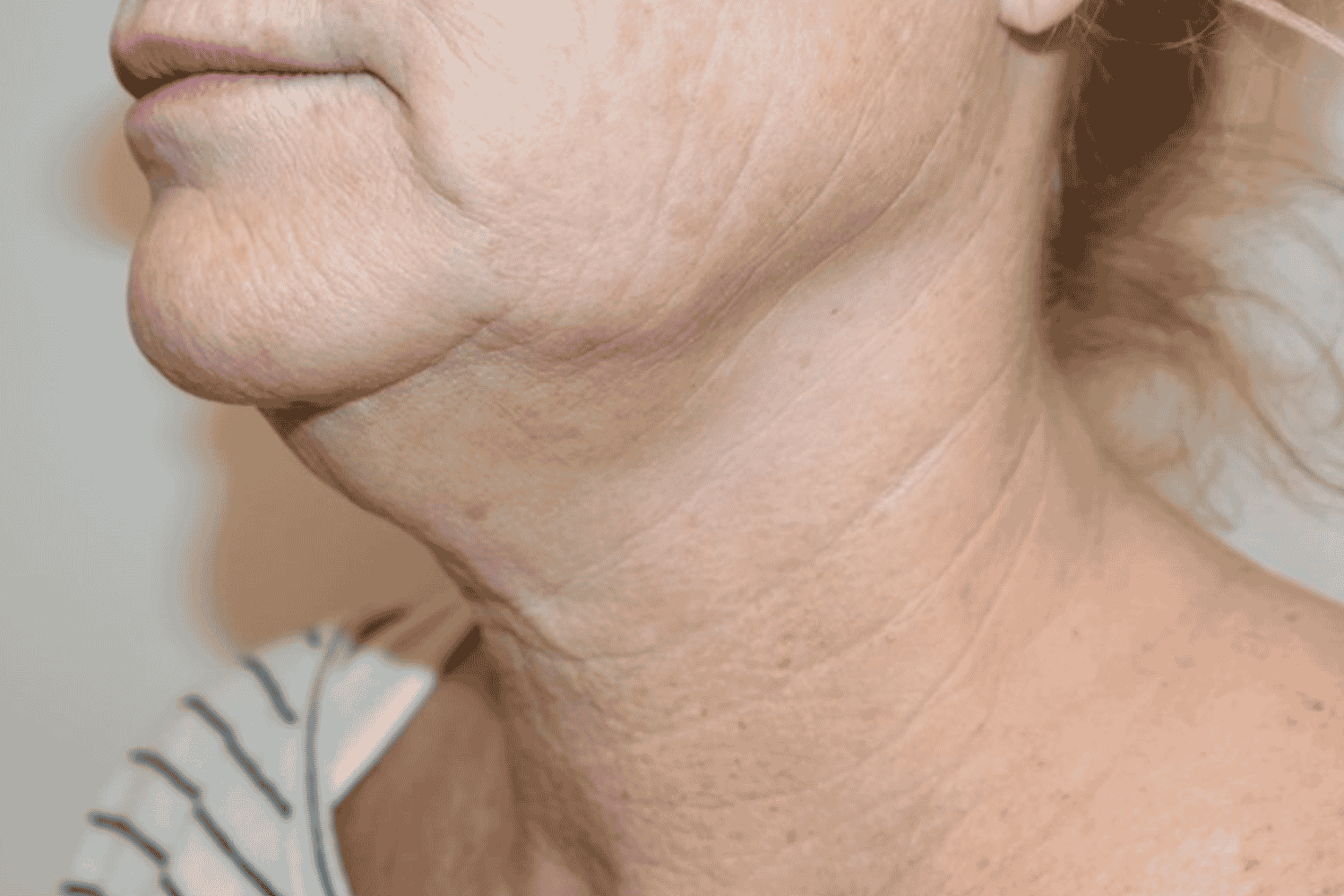 Close neck shot before LaseMD & Genius RF procedure at Regeneris