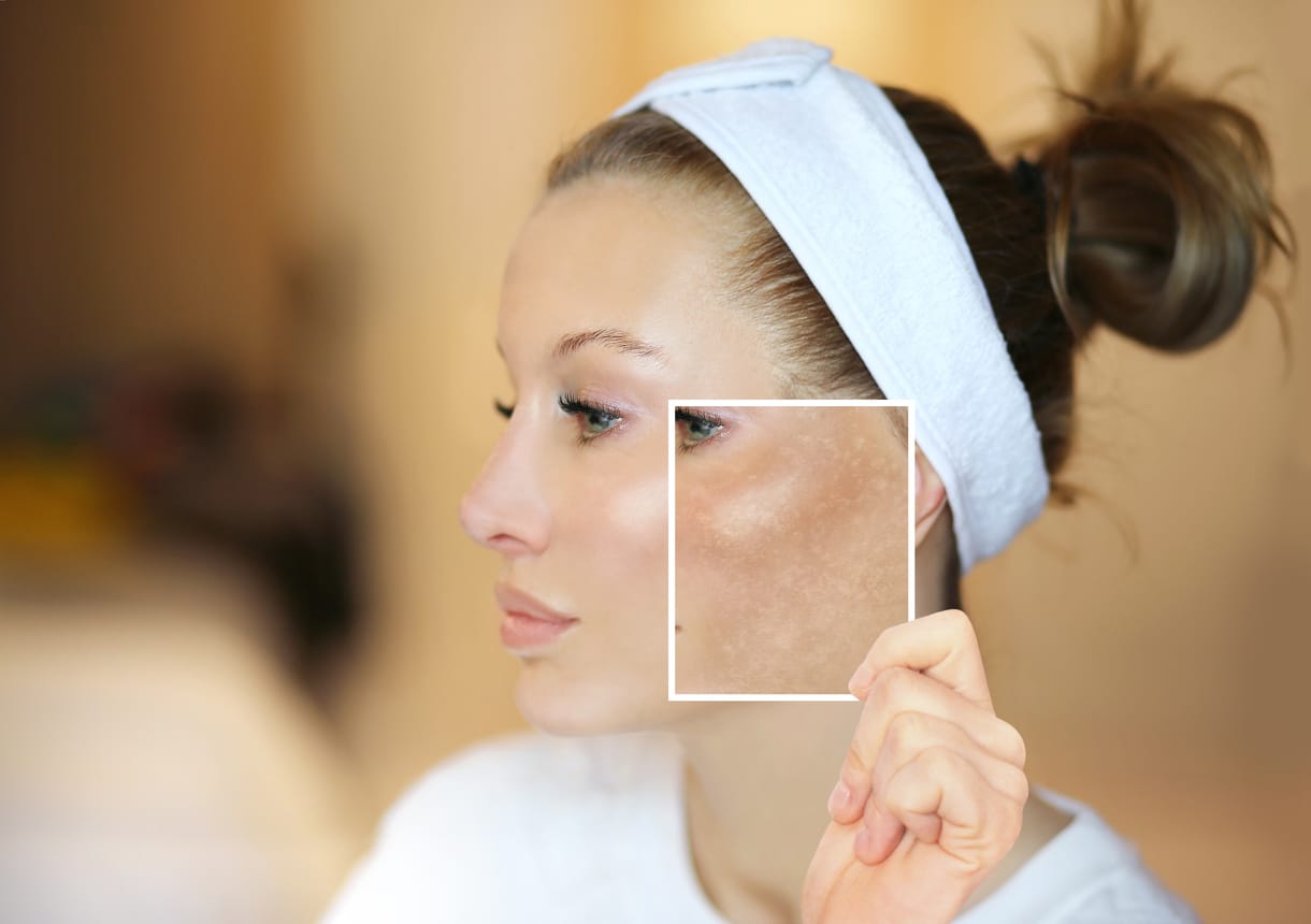 A woman holding up a before look after Melasma Treatment at Regeneris Medspa & Cosmetic Surgery Boston
