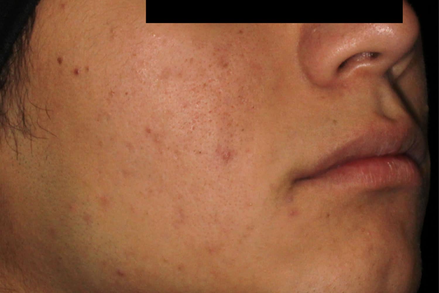 a close up of a man's cheek with less acne after Aviclear Treatment with Regeneris