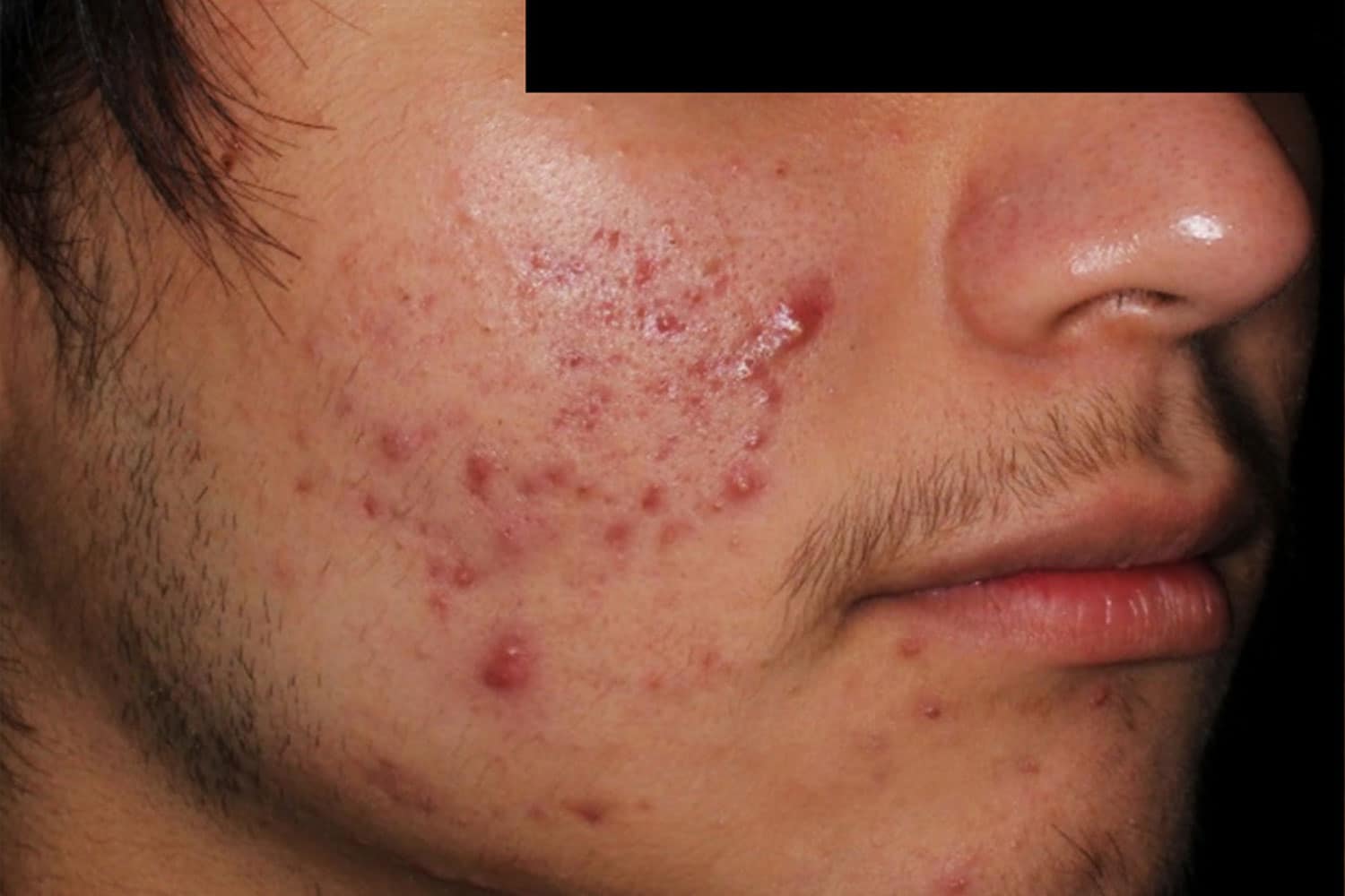 a close up of a man's cheek prior to Aviclear Treatment