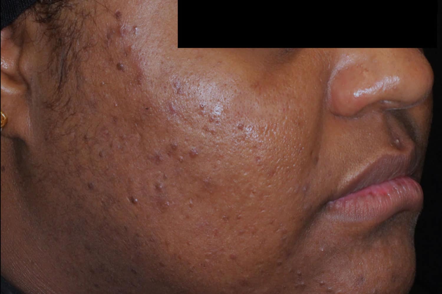 A close up photo of a person's cheek looking better after AviClear treatment with Regeneris Medspa Boston