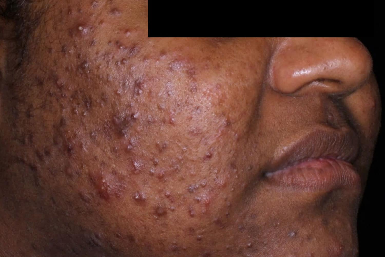 A close up photo of a person's cheek with severe acne prior to AviClear treatment
