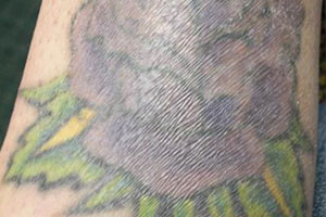 A close up of a tattoo prior to laser removal at Regeneris Medspa Boston