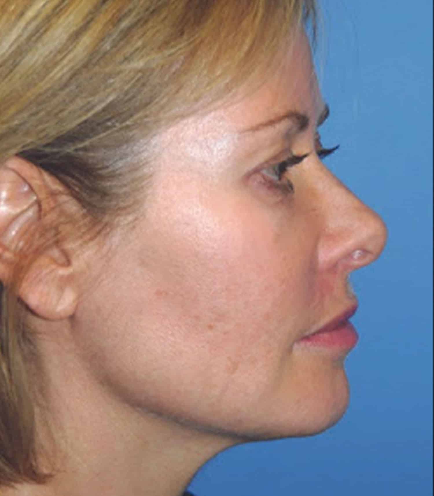A photo of a woman's side view after YLift procedure at Regeneris Medspa Boston
