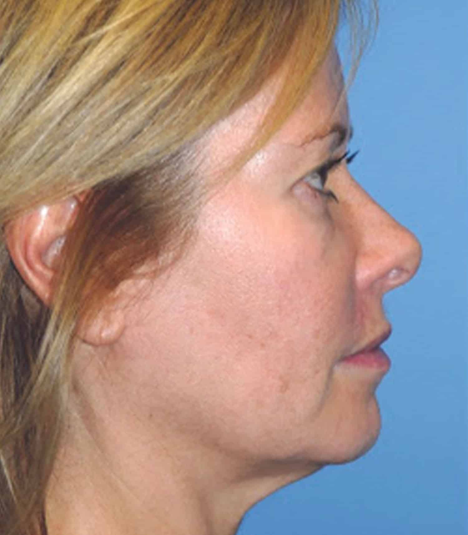 A photo of a woman's side view prior to YLift procedure at Regeneris Medspa Boston