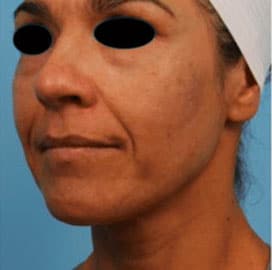 A close up photo of a woman with eyes covered after a Hollywood Facial procedure