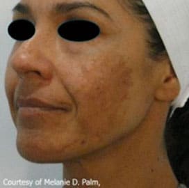 A close up photo of a woman with eyes covered for a Hollywood Facial procedure