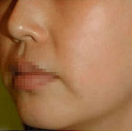A close up photo of a person after the Hollywoord Facial procedure at Regeneris Medspa