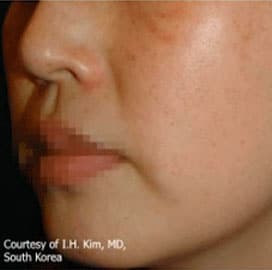 A close up photo of a person prior the conduct of Hollywoord Facial procedure at Regeneris Medspa