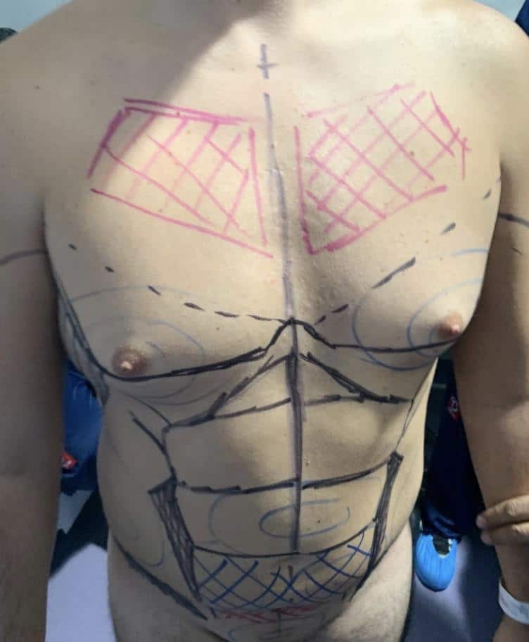 A photo of a man's body drawn lines prior to vaserlipo procedure at Regeneris Medspa Boston