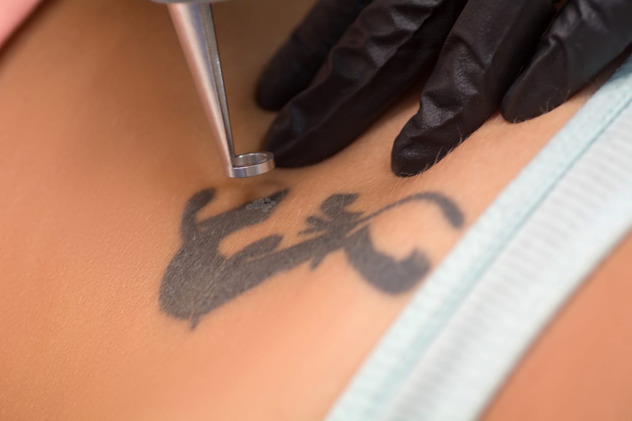 A silver laser tattoo removal wand is positioned above a black tattoo on a patient’s stomach