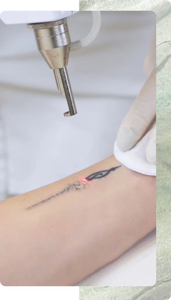 Laser Tattoo Removal Procedure: Step by Step Banner